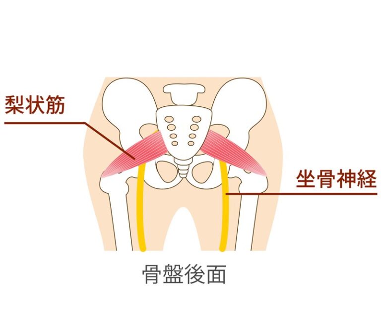 坐骨神経痛のメカニズムの図
