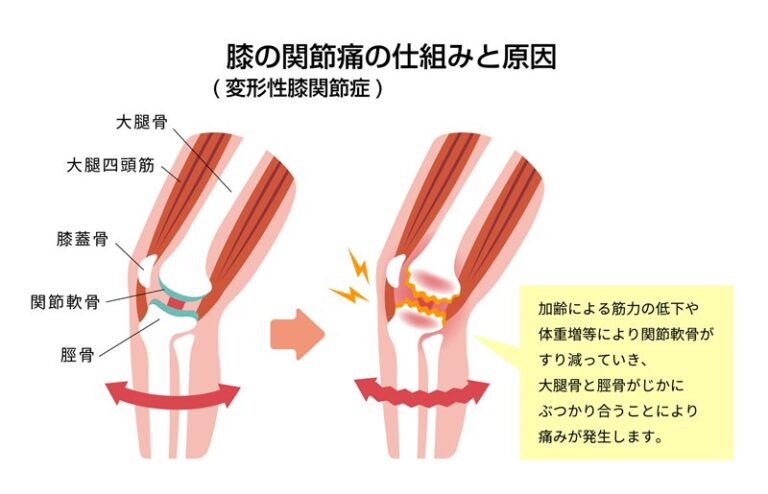 膝関節痛の図(変形性膝関節症)